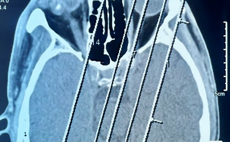 The foreign object in the eye is pressured, causing the eyeball to deform moderately. Photo: Provided by the hospital