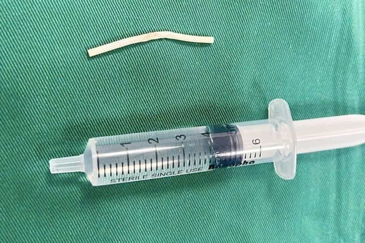 The " lac" birth certificate was taken out of the patient's arm. Photo: Vietnam - Sweden Uong Bi Hospital (Quang Ninh)