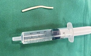 Các bác sĩ Quảng Ninh lấy thành công que tránh thai đi lạc vào cơ bắp tay