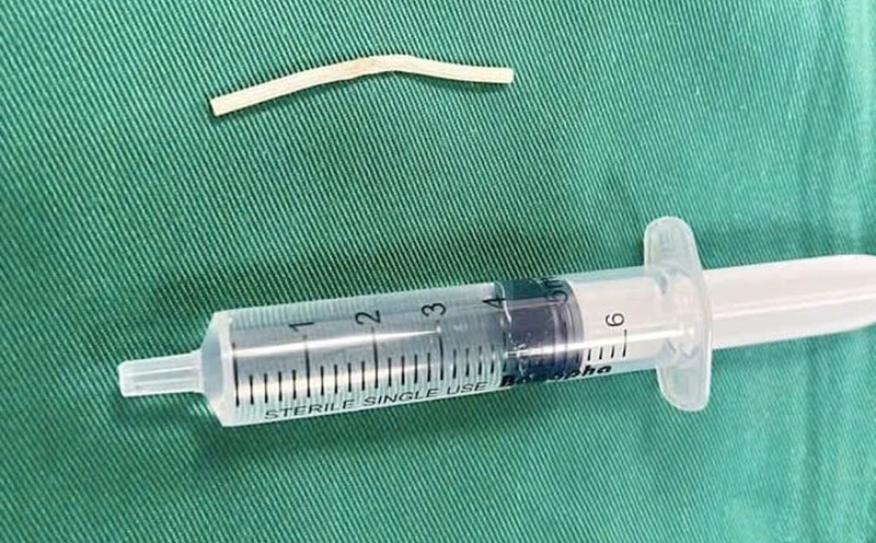 The " lac" birth certificate was taken out of the patient's arm. Photo: Vietnam - Sweden Uong Bi Hospital (Quang Ninh)