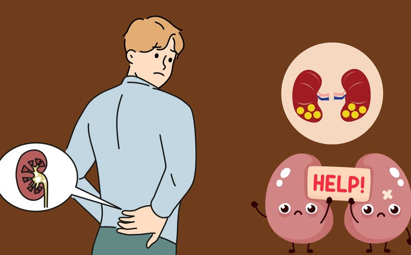 Some habits can cause kidney stones. Graphics: Ha May