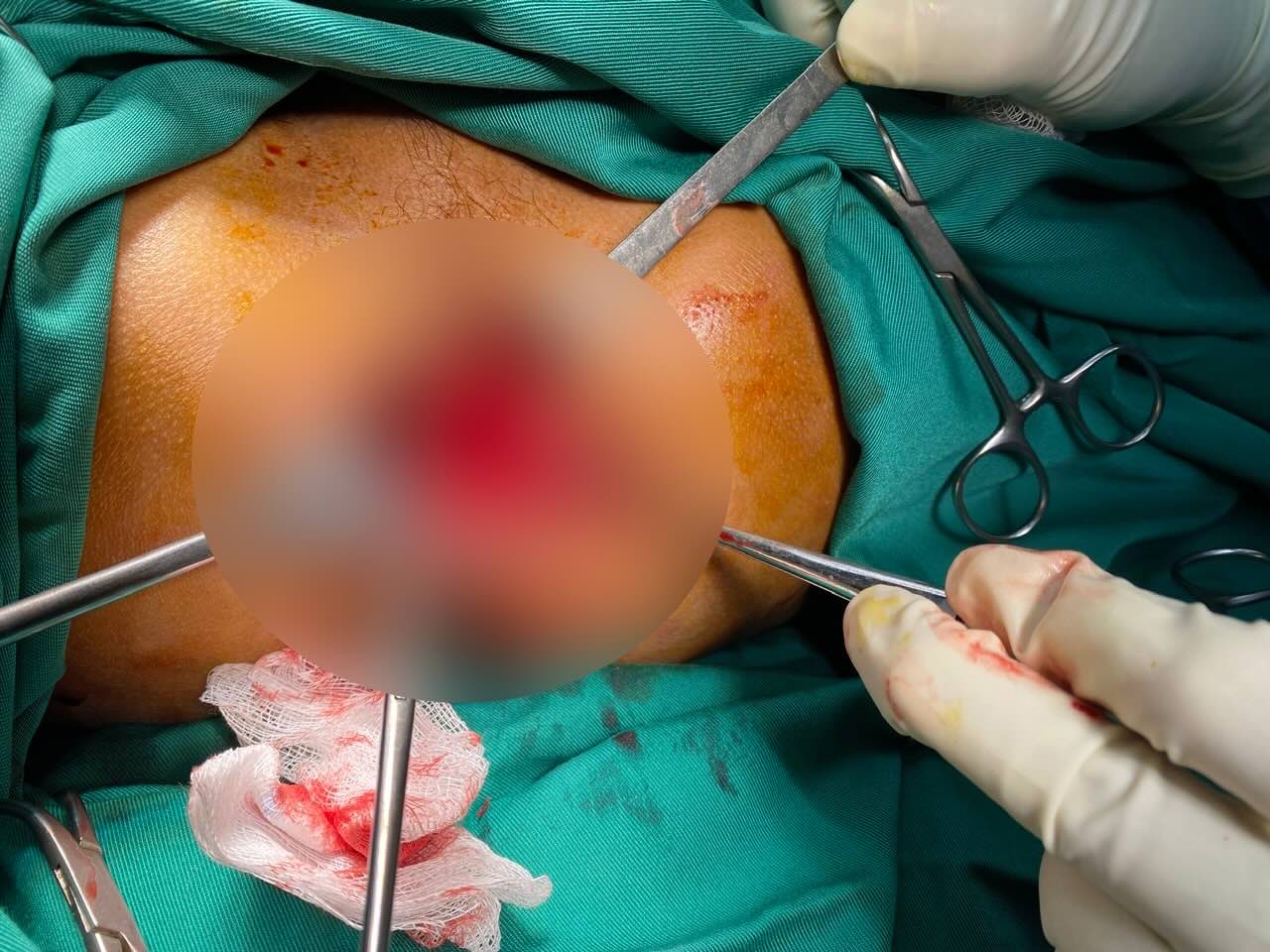 The man was saved when being stabbed with a beng along his body. Photo: Vietnam - Cuba Dong Hoi Friendship Hospital