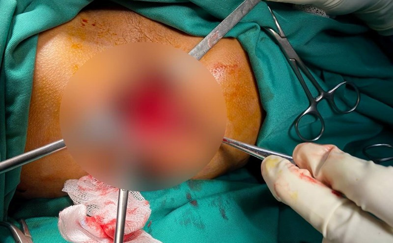 The man was saved when being stabbed with a beng along his body. Photo: Vietnam - Cuba Dong Hoi Friendship Hospital