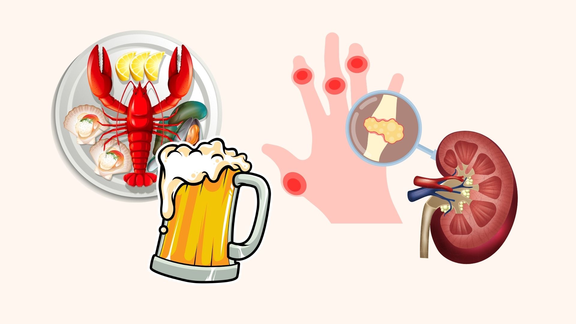 High uric acid can silently cause kidney stones. Graphics: Linh Dan