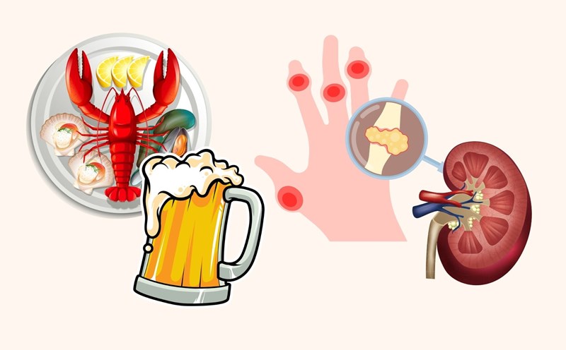 High uric acid can silently cause kidney stones. Graphics: Linh Dan