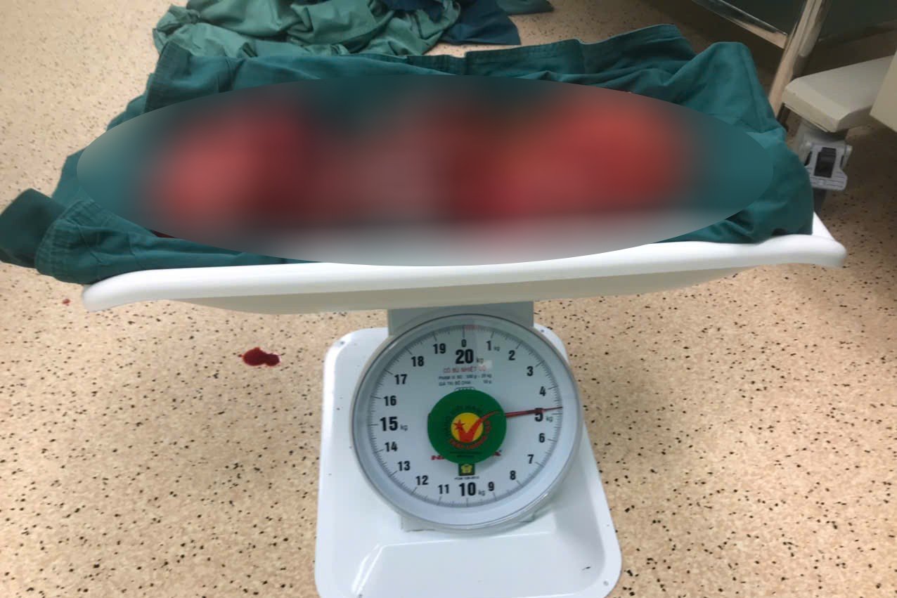 Khoi u cat bo tu benh nhan co trong luong gan 5kg. Anh: BVVT cung cap
