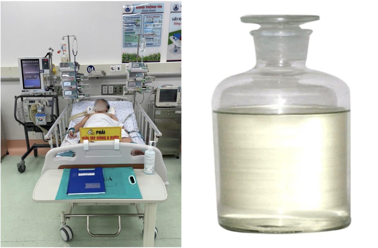 A healthy 13-year-old boy suddenly fell into a coma and suffered from severe respiratory failure due to inhaling the toxic gas styrene used to weld plastic. Photo: Provided by the Ho Chi Minh City Department of Health