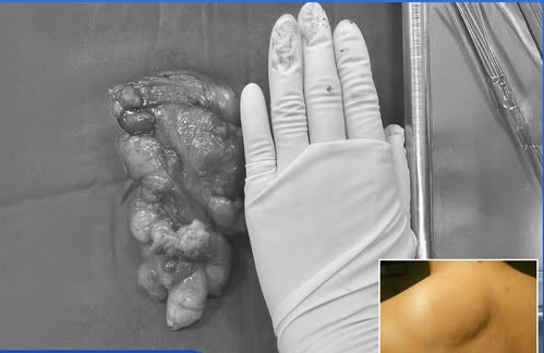 The giant fat tumor was successfully peeled off. Photo: BVCC