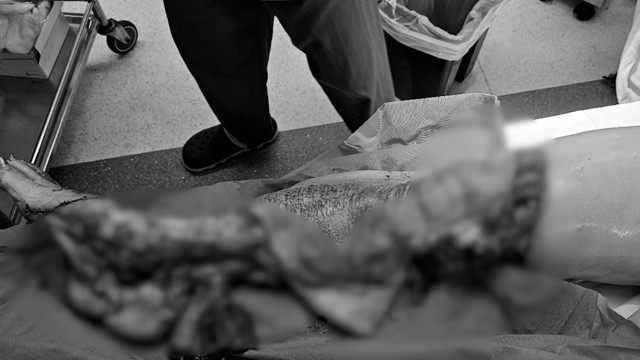 The truck passed the patient's leg while being admitted to the hospital. Photo: Provided by the hospital