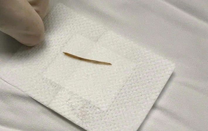 The fish bone scraps were removed by a surgeon. Photo: Provided by the hospital