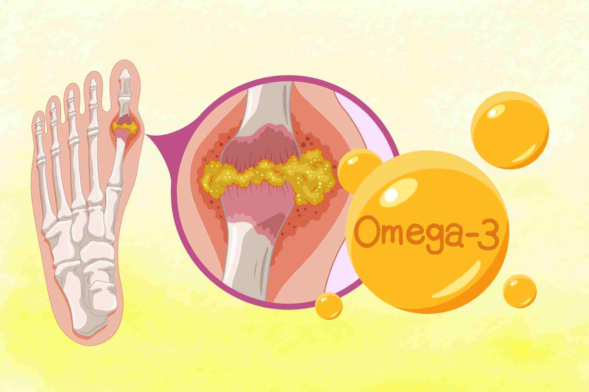 Ideal omega-3 intake for people with high uric acid should not be ignored. Graphics: Dinh Dinh