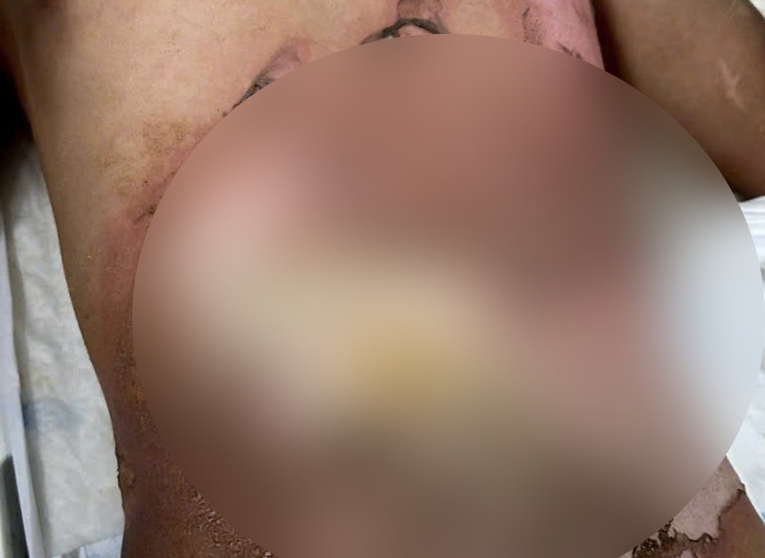 The boy suffered electrical burns while playing a kite near a high-voltage power line. Photo: Bac Quang Binh Regional General Hospital