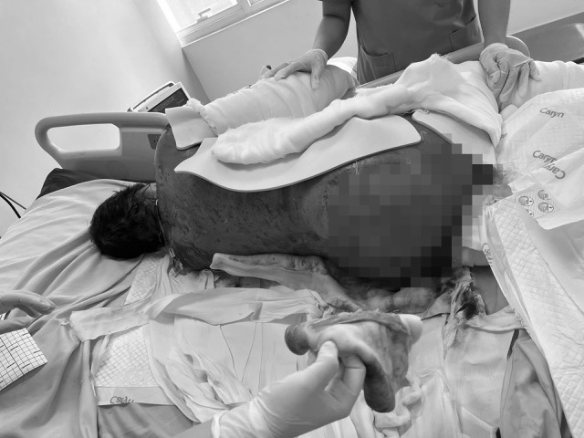 The patient suffered a rare whole-body skin injury. Photo: Military Hospital 175