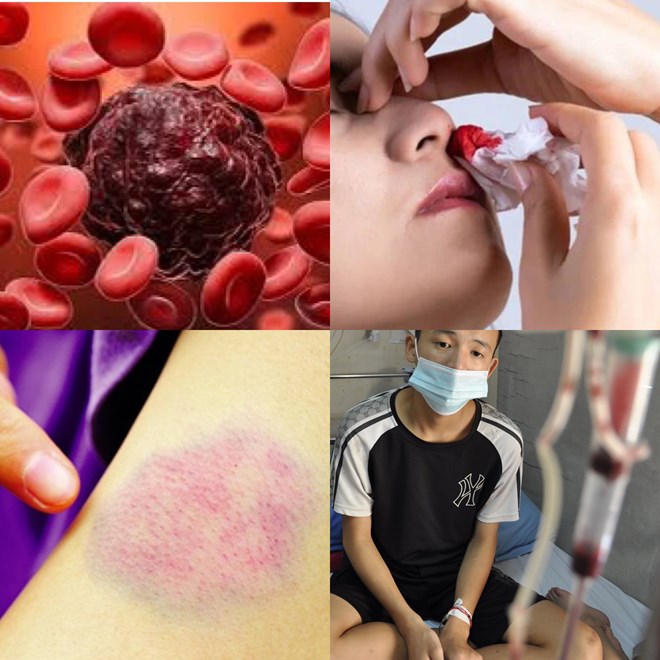 Symptoms of leukemia. Graphics: Huong Giang