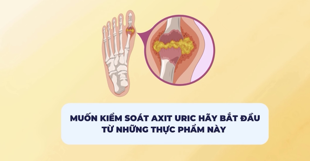 To control uric acid, start with these foods