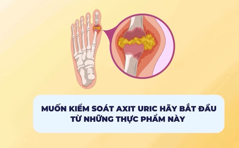 To control uric acid, start with these foods