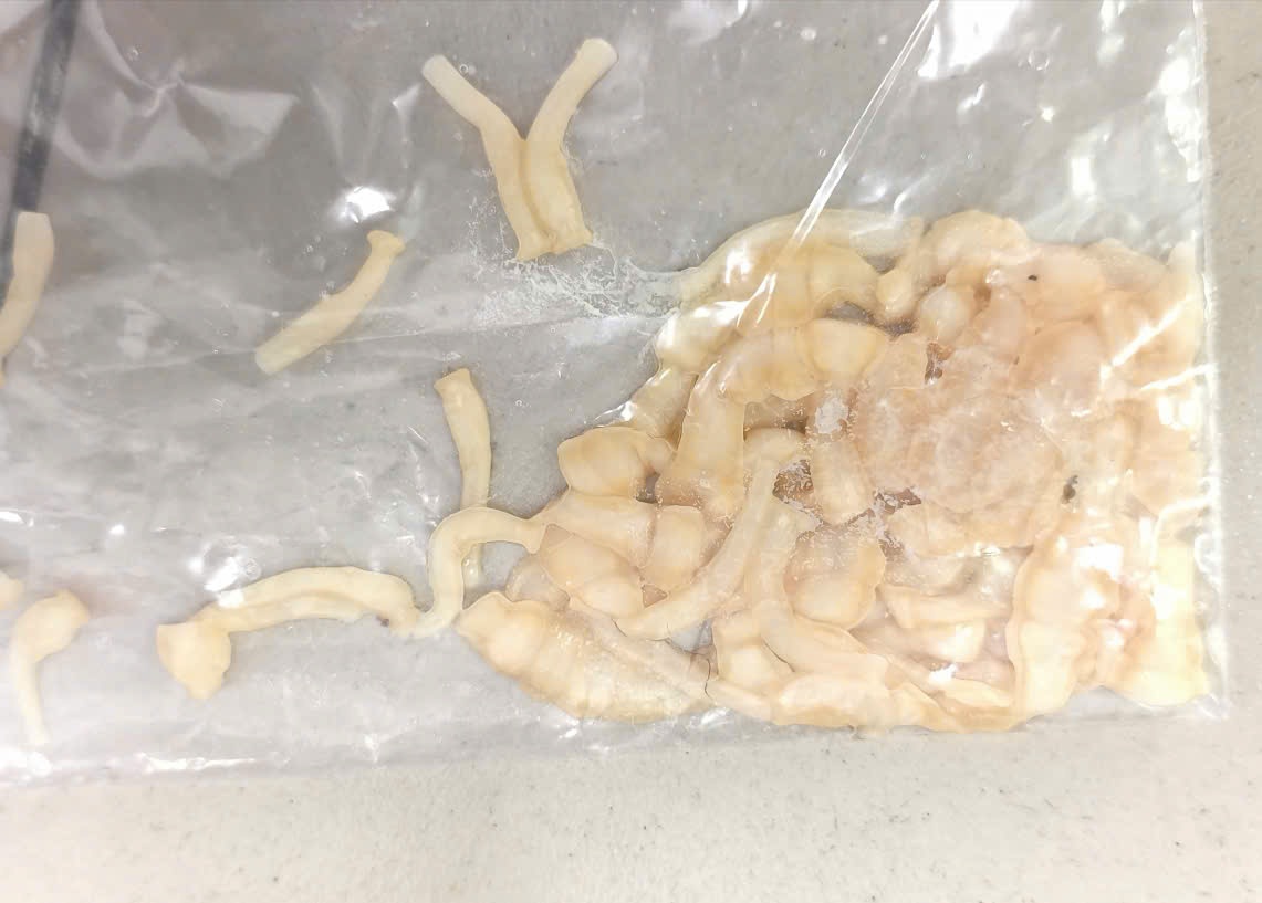 The band was taken from the patient. Photo: Thanh Dang