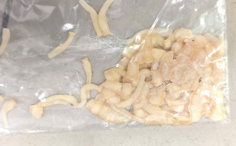 The band was taken from the patient. Photo: Thanh Dang