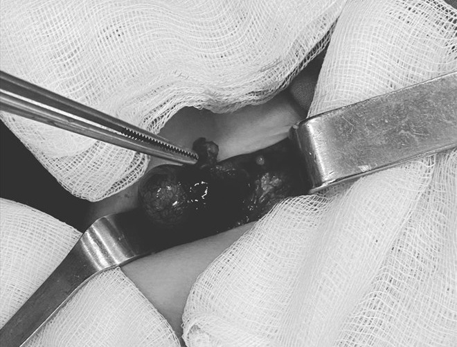 A testicular torsion surgery required a cut on one side. Photo: BVCC