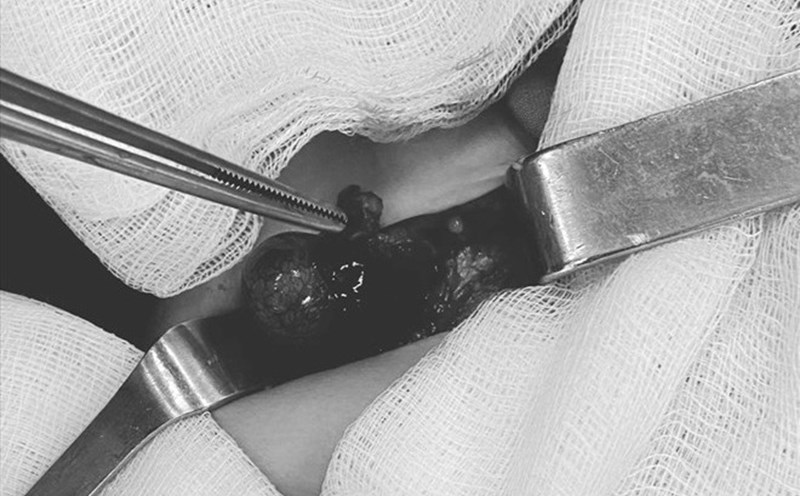 A testicular torsion surgery required a cut on one side. Photo: BVCC