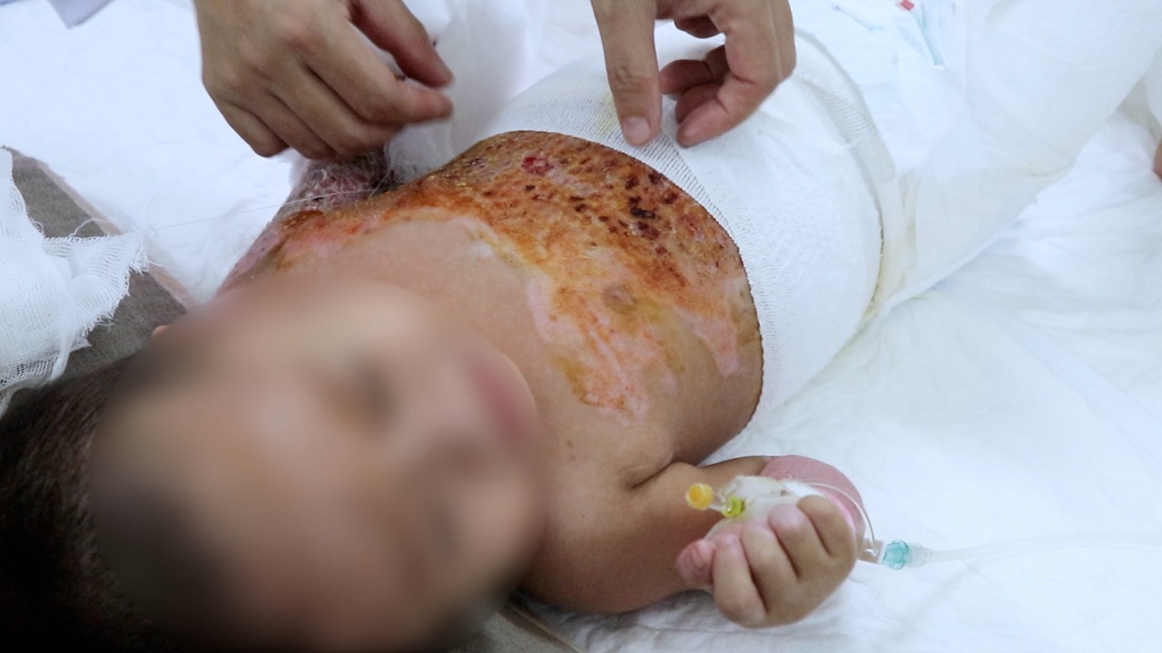 The patient was lucky to have the burned skin transplanted in time and is currently recovering well. Photo: Nhu Thuy