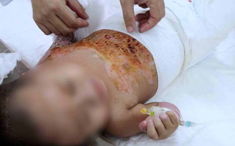 The patient was lucky to have the burned skin transplanted in time and is currently recovering well. Photo: Nhu Thuy
