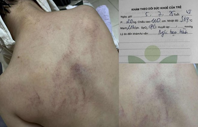 Image of a 4-year-old girl in Hanoi being beaten by a teacher, showing many bruises. Photo: Provided by the family