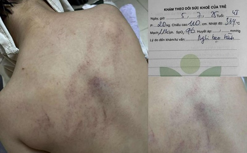 Image of a 4-year-old girl in Hanoi being beaten by a teacher, showing many bruises. Photo: Provided by the family
