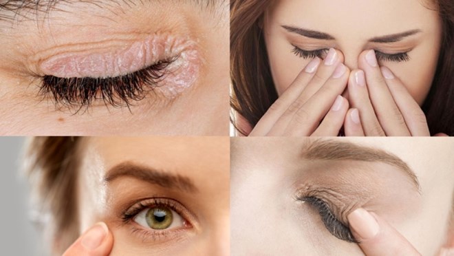 まつげのたるみ、小さな問題に見えるかもしれないが、目の大きな危険を秘めている。グラフィック:Han Lam