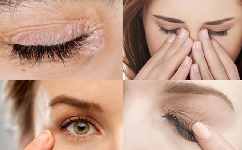 Measles, a seemingly small problem but poses a great risk to the eyes. Graphics: Han Lam