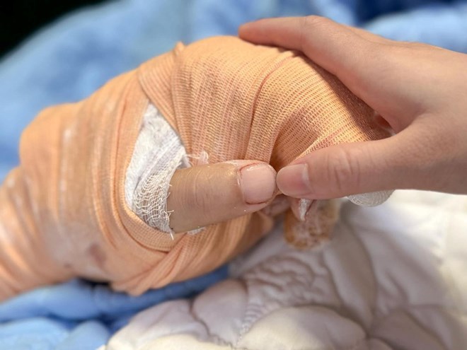 Nối thành công bàn tay bị chém đứt lìa cho nam tiktoker ở Thái Nguyên