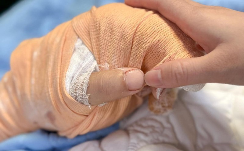 Tiktoker H's hand was successfully reattached. Photo: Doctor Nguyen Thanh Tung.