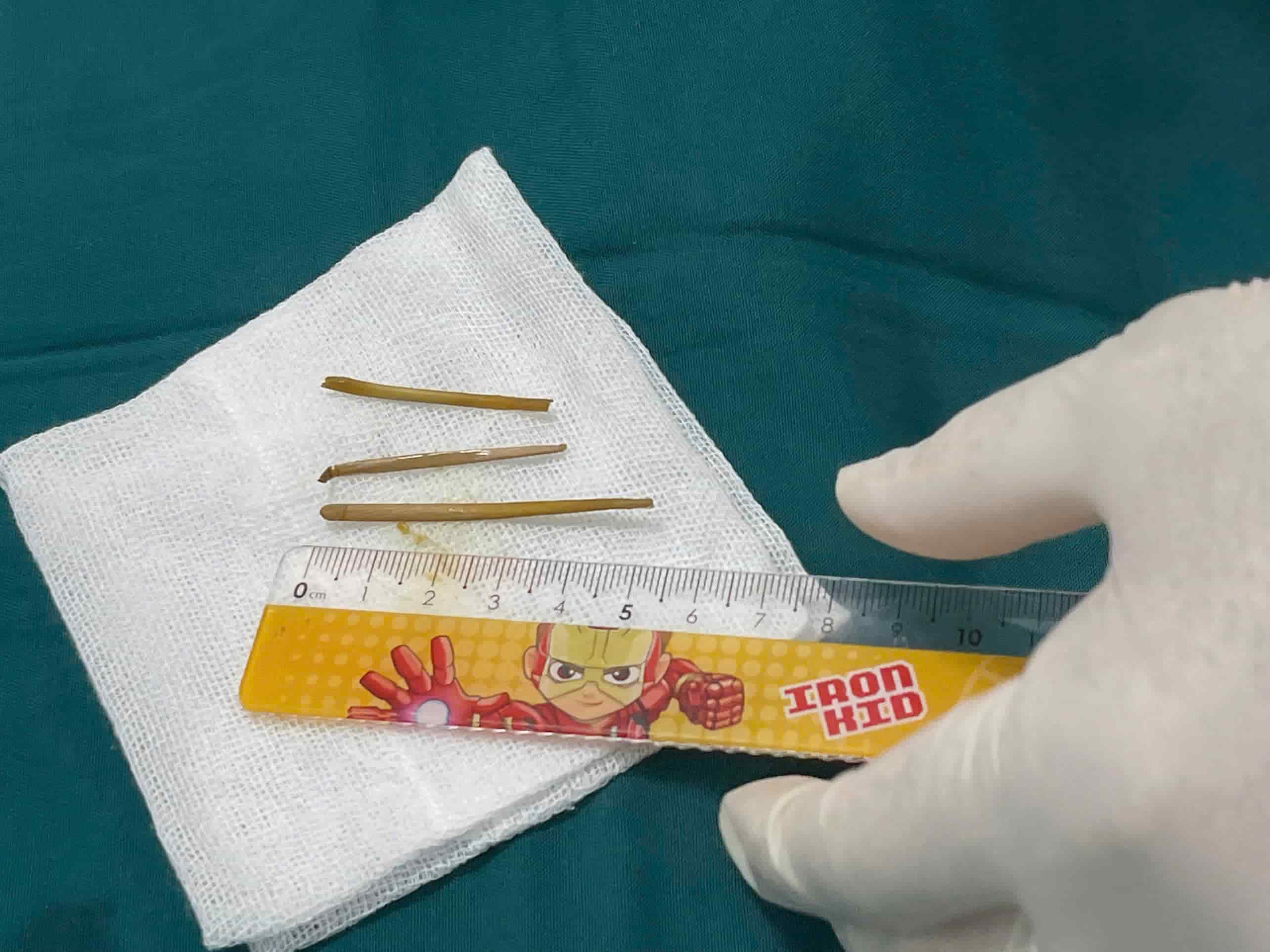 Doctors in Khanh Hoa have just discovered 3 long bones in the colon after more than 1 year of amputated abdominal pain. Photo: Huu Long