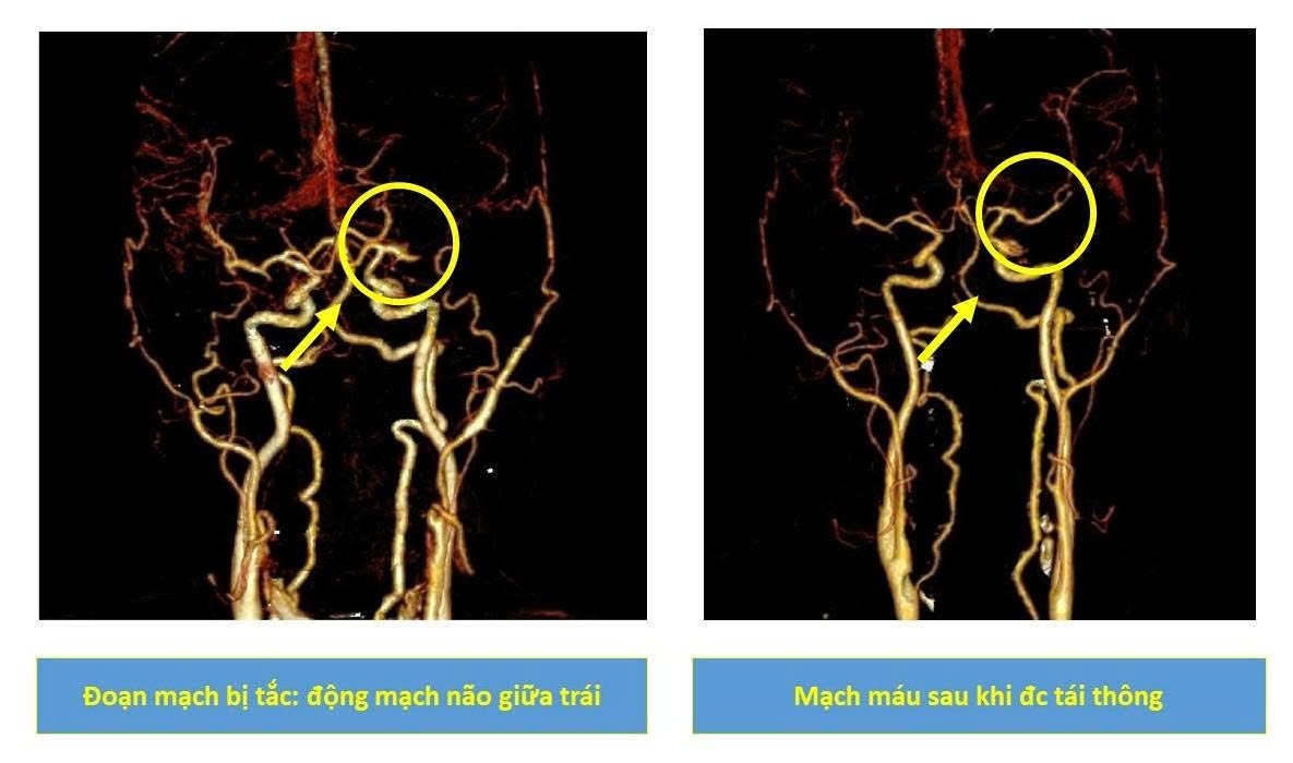 Through examination combined with diagnostic measures, the doctor determined that the patient had a stroke. Photo: BVCC