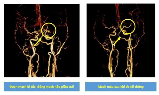 Qua thăm khám kết hợp các biện pháp chẩn đoán hình ảnh bác sĩ nhận định người bệnh bị đột quỵ. Ảnh: BVCC