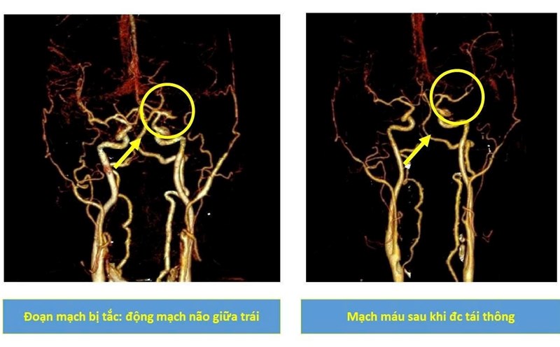 Through examination combined with diagnostic measures, the doctor determined that the patient had a stroke. Photo: BVCC