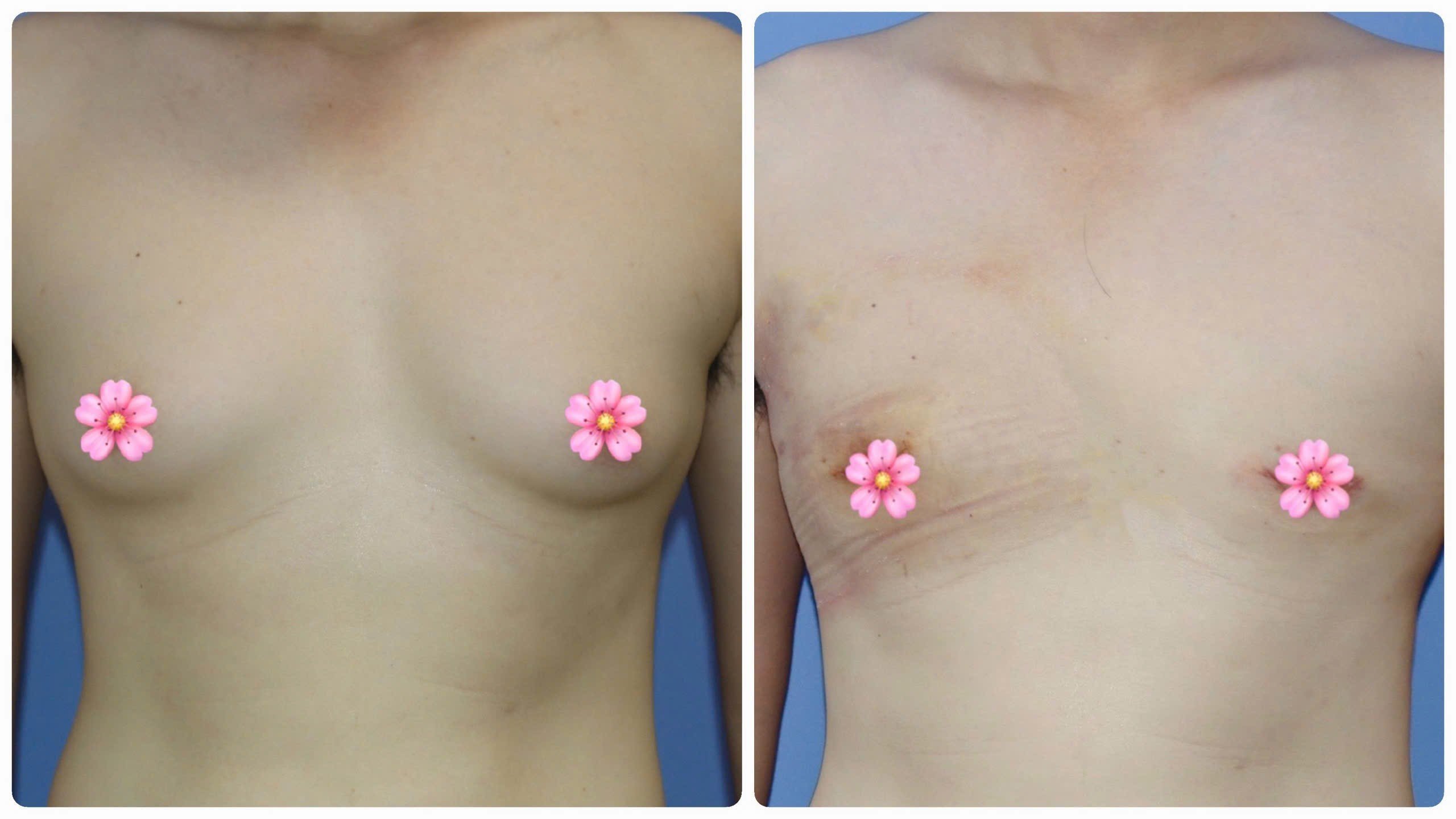 Before and after treatment of enlarged breast in men. Photo: BVCC