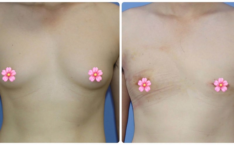 Before and after treatment of enlarged breast in men. Photo: BVCC