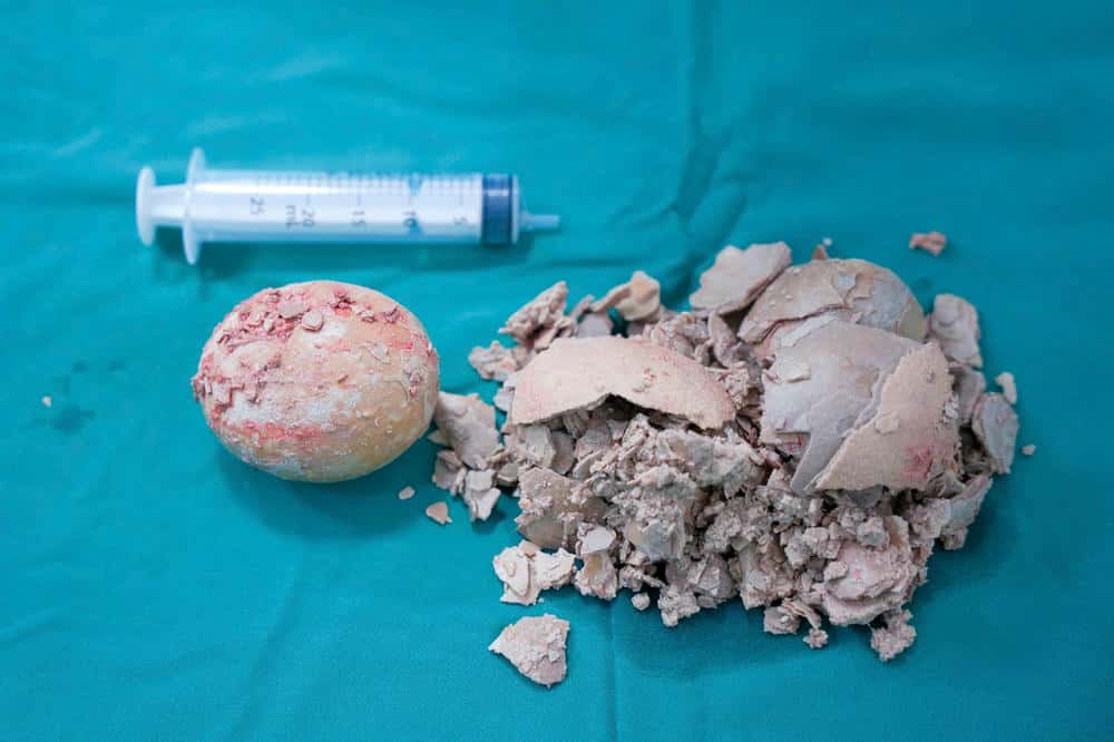 患者の体から採取された巨大な結石。写真:Thanh Tuan