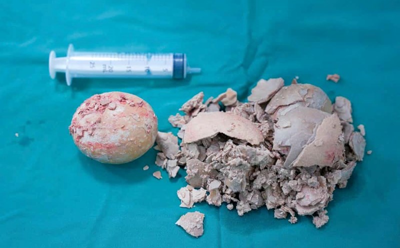 The giant stone was taken from the patient's body. Photo: Thanh Tuan