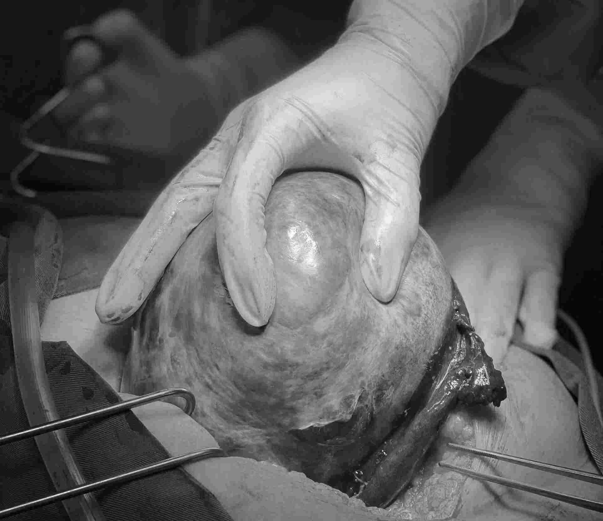 Se elimina el tumor ovarico. Foto: BVCC