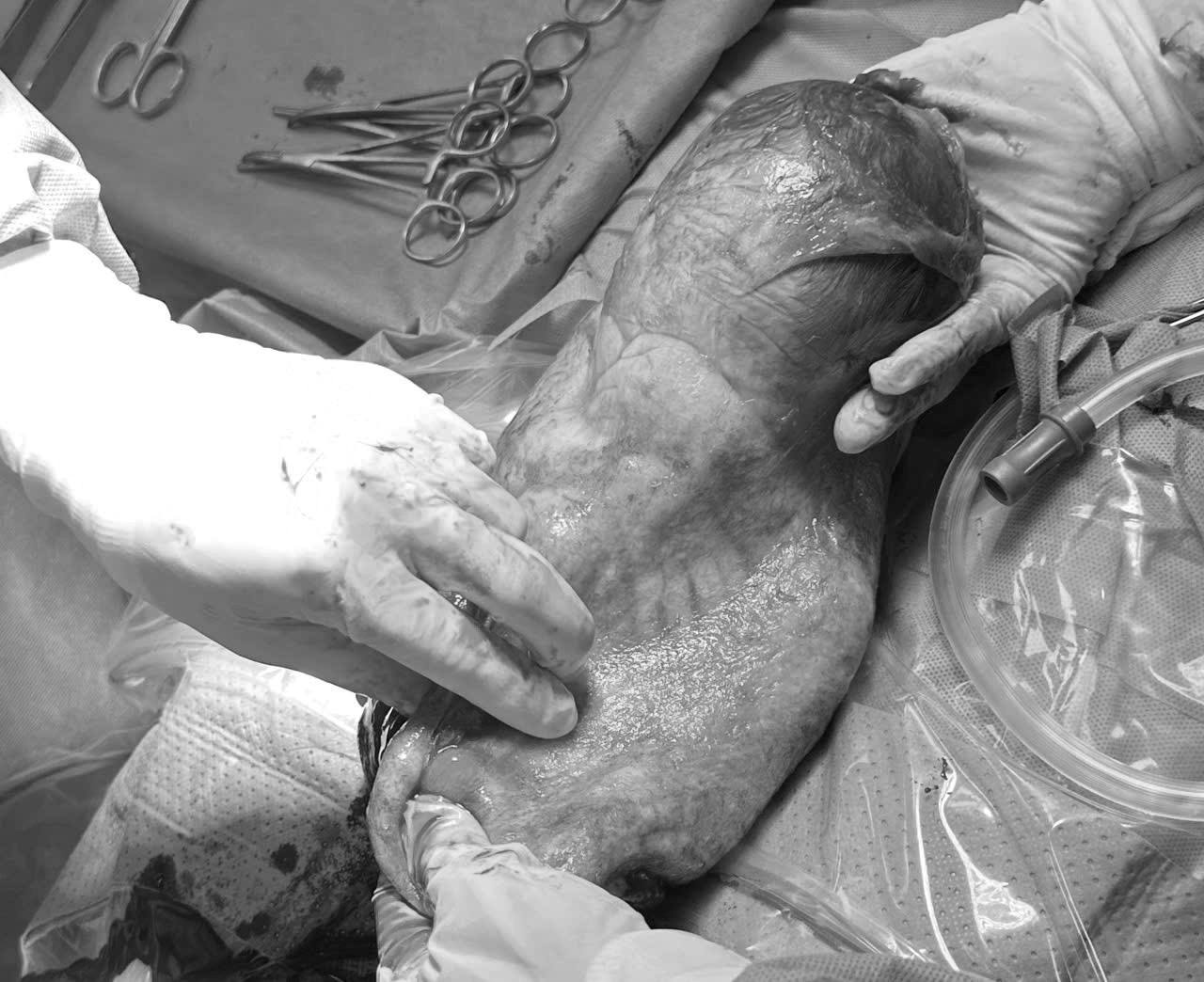 The boy was begged to be safe in the sack. Photo: Hai Phong Obstetrics and Gynecology Center