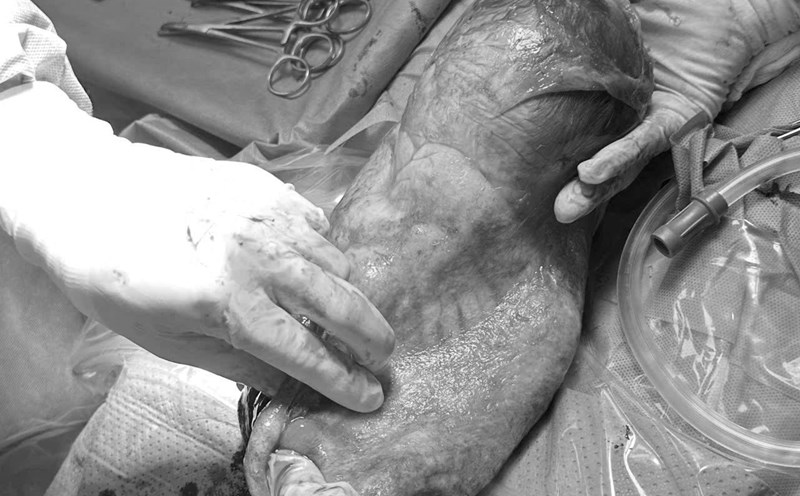 The boy was begged to be safe in the sack. Photo: Hai Phong Obstetrics and Gynecology Center