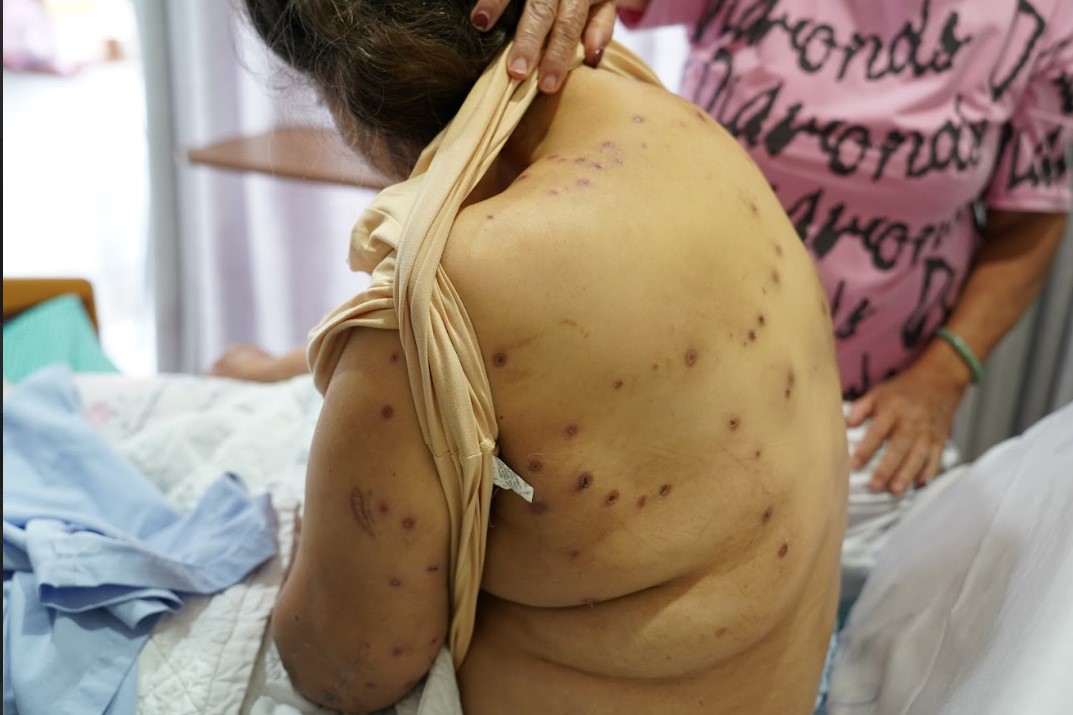 Many bee stings were on the patient's hands, feet, back, head, and face. Photo: Provided by the hospital