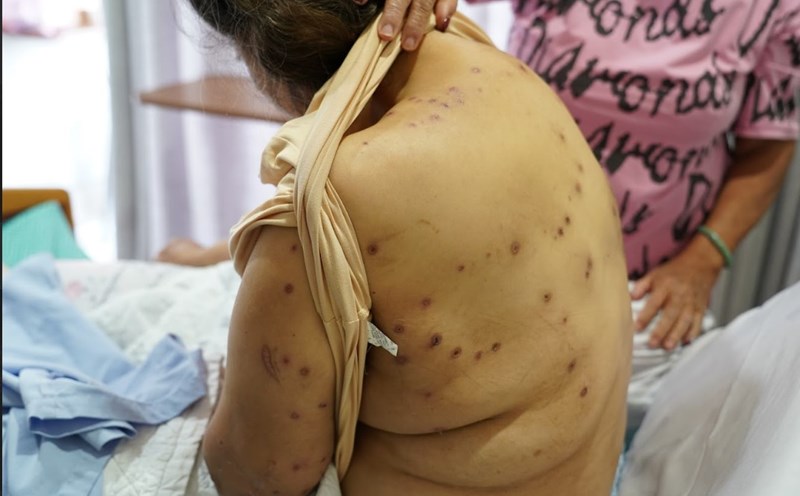 Many bee stings were on the patient's hands, feet, back, head, and face. Photo: Provided by the hospital