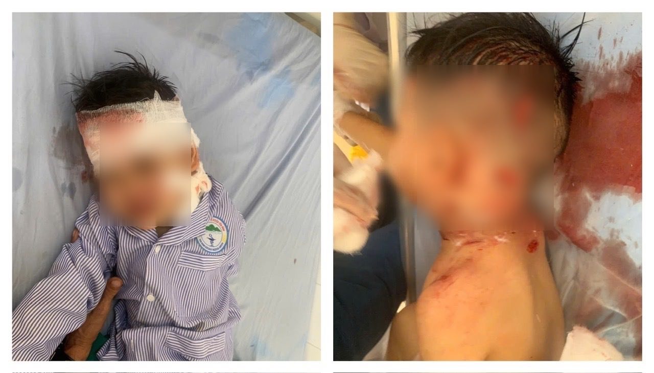 A 3-year-old boy in Lao Cai was bitten by a dog and had a broken vein. Photo: Van Duc