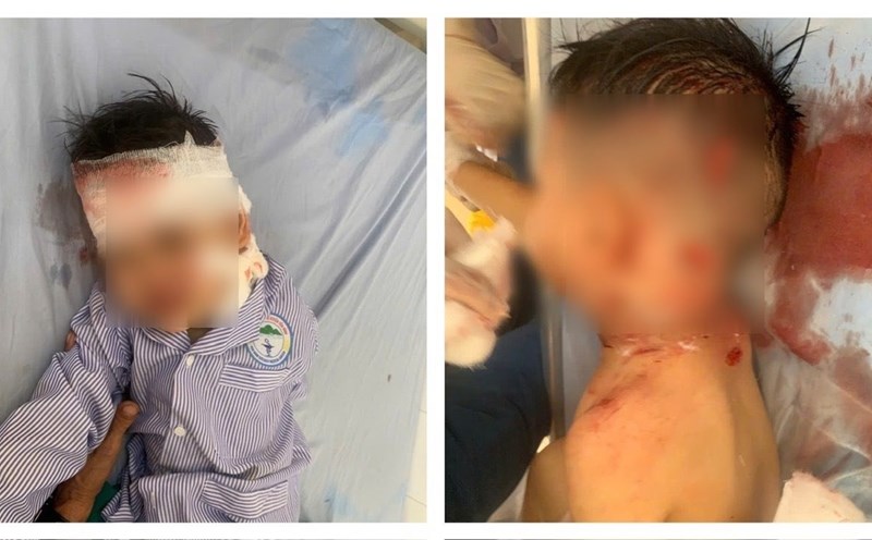A 3-year-old boy in Lao Cai was bitten by a dog and had a broken vein. Photo: Van Duc