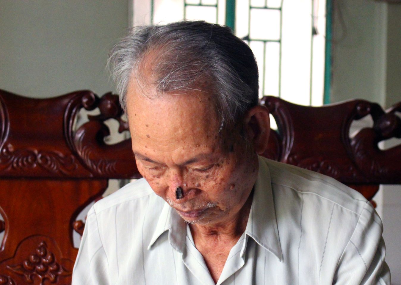 Ong Hoang Dung va vet mo lan thu 2 tu di chung benh ung thu. Anh: Luc Tung