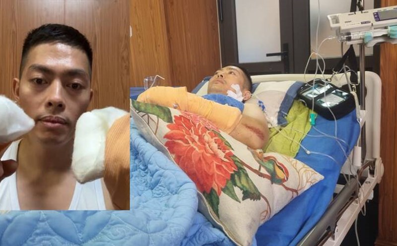 As soon as he left the hospital, Tiktoker Ha List scheduled to share the incident of his hand being slashed by a langur. Photo: Lam Thanh