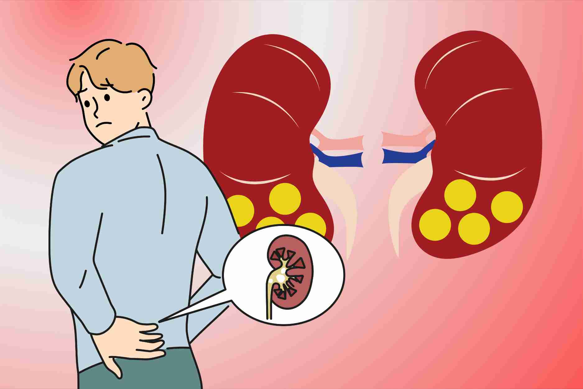 3 simple habits to effectively prevent kidney stones